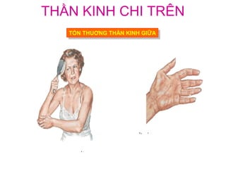 THẦN KINH CHI TRÊN
   TỔN THUƠNG THẦN KINH GIỮA
    TỔN THUƠNG THẦN KINH GIỮA
 