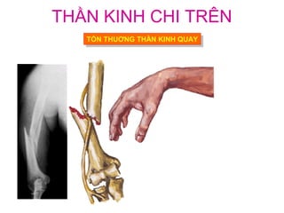 THẦN KINH CHI TRÊN
   TỔN THUƠNG THẦN KINH QUAY
    TỔN THUƠNG THẦN KINH QUAY
 