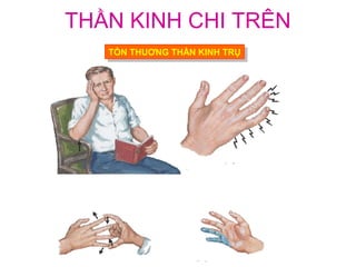 THẦN KINH CHI TRÊN
   TỔN THUƠNG THẦN KINH TRỤ
    TỔN THUƠNG THẦN KINH TRỤ
 