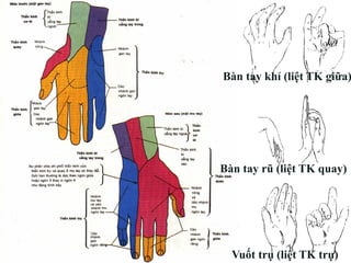 Bàn tay khỉ (liệt TK giữa)
Bàn tay rũ (liệt TK quay)
Vuốt trụ (liệt TK trụ)
 