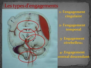 1- l'engagement
cingulaire
2- l'engagement
temporal
3- Engagement
cérebelleux
4- Engagement
central descendant
 