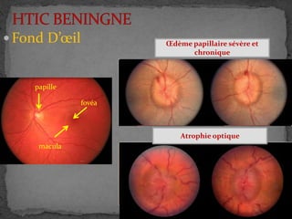  Fond D’œil
papille
macula
fovéa
Œdème papillaire modéré
Œdème papillaire sévère
Œdème papillaire sévère et
chronique
Atrophie optique
 