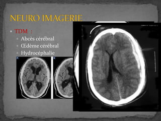 TDM :
 Abcès cérébral
 Œdème cérébral
 Hydrocéphalie
 Hématome sous durale
 