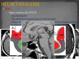  IRM :
 Signe indirect de HTICB
 Arachnoidocéle
 Tige pituitaire baignant dans la selle turcique
 Aspect en croix ou en T du chiasma et tige pituitaire baignant dans
la selle turcique
 