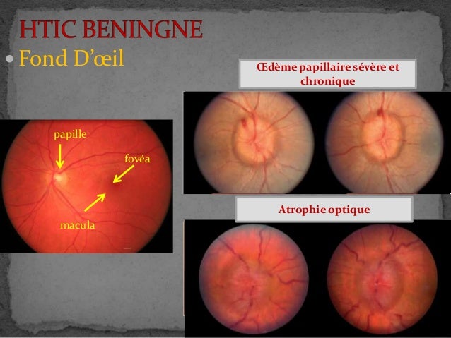 HTIC - Hypertension intracrânienne