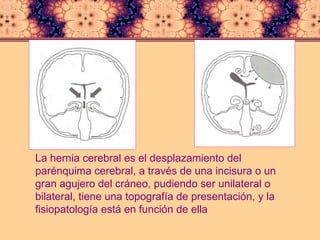 La hernia cerebral es el desplazamiento del parénquima cerebral, a través de una incisura o un gran agujero del cráneo, pudiendo ser unilateral o bilateral, tiene una topografía de presentación, y la fisiopatología está en función de ella 