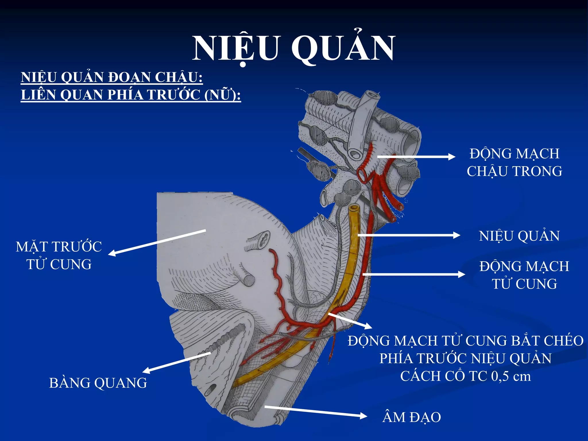 ÂM ĐẠO
MẶT TRƢỚC
TỬ CUNG
ĐỘNG MẠCH
CHẬU TRONG
NIỆU QUẢN
ĐỘNG MẠCH
TỬ CUNG
ĐỘNG MẠCH TỬ CUNG BẮT CHÉO
PHÍA TRƢỚC NIỆU QUẢN
CÁCH CỔ TC 0,5 cmBÀNG QUANG
NIỆU QUẢN ĐOẠN CHẬU:
LIÊN QUAN PHÍA TRƢỚC (NỮ):
NIỆU QUẢN
 
