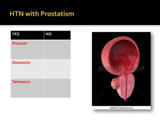 YES NO
Prazocin
Doxazocin
Tetrazocin
 