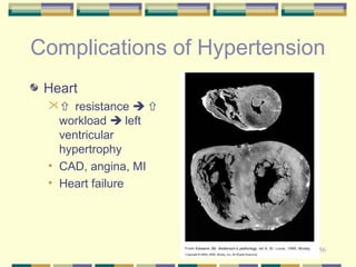 Complications of Hypertension 
Heart 
56 
 resistance   
workload  left 
ventricular 
hypertrophy 
• CAD, angina, MI 
• Heart failure 
 