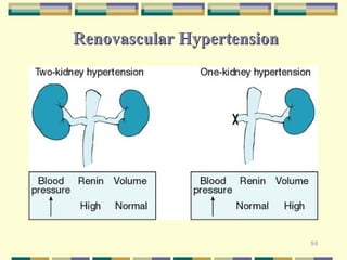 84 
Renovascular Hypertension 
 