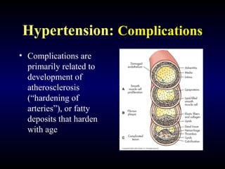 Hypertension: Complications
• Complications are
primarily related to
development of
atherosclerosis
(“hardening of
arteries”), or fatty
deposits that harden
with age
 