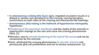 • In arteriovenous nicking (the Gunn sign), impeded circulation results in a
dilated or swollen vein peripheral to the crossing, causing hourglass
constrictions on both sides of the crossing and aneurysmal-like swellings.
• Arteriovenous (AV) nicking is the hallmark of hypertensive retinopathy
Hypotheses:
Thickening of the basement membrane and the media of the arteriole in
hypertension impinge on the vein and cause the crossing phenomenon
(Ikui). [1]
Mimatsu: due to sclerotic thickening of the wall of the venule and not by
compression by the arteriole
Seitz: attributed the crossing phenomenon to vascular sclerosis and
perivascular glial cell proliferation and not to venous compression. [1]
 