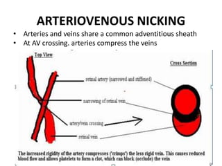 ARTERIOVENOUS NICKING
• Arteries and veins share a common adventitious sheath
• At AV crossing. arteries compress the veins
 