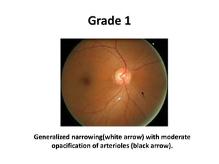 Grade 1
Generalized narrowing(white arrow) with moderate
opacification of arterioles (black arrow).
 