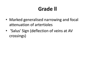Grade ll
• Marked generalised narrowing and focal
attenuation of artertioles
• 'Salus' Sign (deflection of veins at AV
crossings)
 