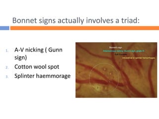Bonnet signs actually involves a triad:
1. A-V nicking ( Gunn
sign)
2. Cotton wool spot
3. Splinter haemmorage
 