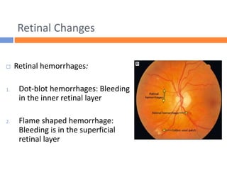 Retinal Changes
 Retinal hemorrhages:
1. Dot-blot hemorrhages: Bleeding
in the inner retinal layer
2. Flame shaped hemorrhage:
Bleeding is in the superficial
retinal layer
 
