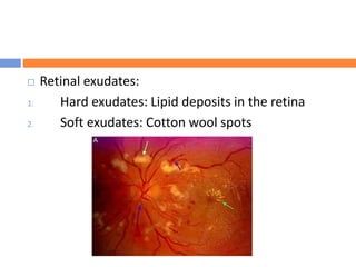  Retinal exudates:
1. Hard exudates: Lipid deposits in the retina
2. Soft exudates: Cotton wool spots
 