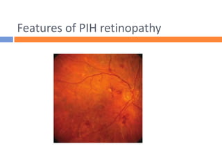 Features of PIH retinopathy
 