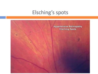 Elsching’s spots
 