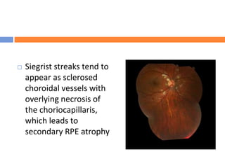  Siegrist streaks tend to
appear as sclerosed
choroidal vessels with
overlying necrosis of
the choriocapillaris,
which leads to
secondary RPE atrophy
 
