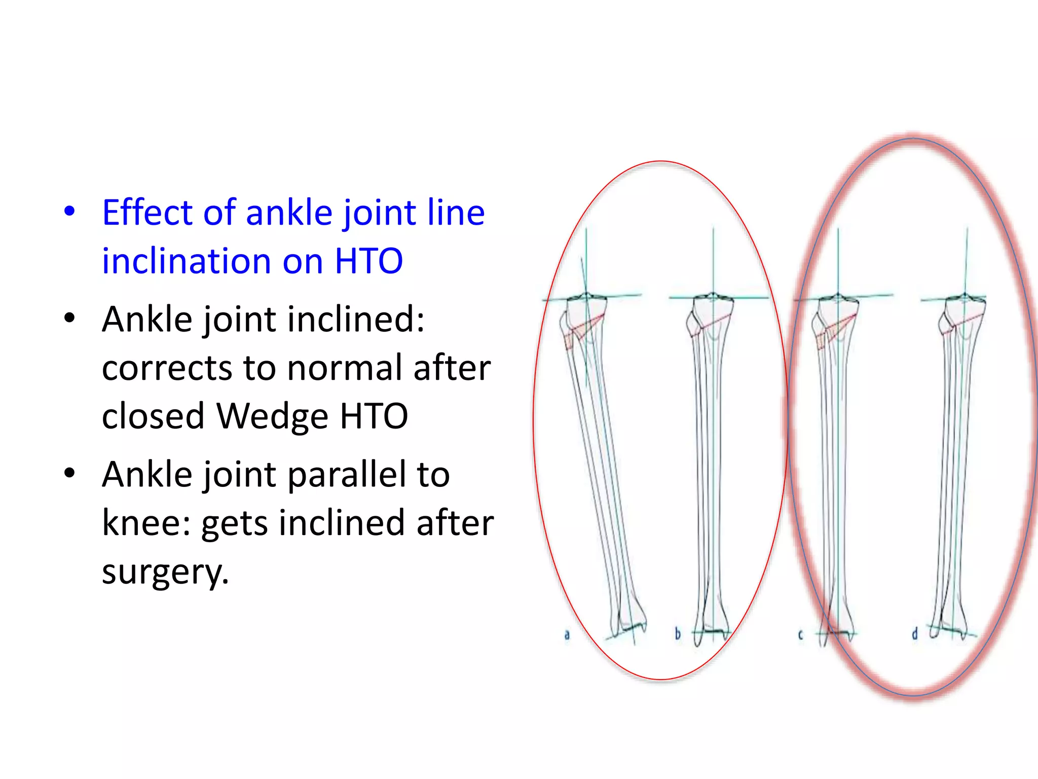 • Effect of ankle joint line
inclination on HTO
• Ankle joint inclined:
corrects to normal after
closed Wedge HTO
• Ankle joint parallel to
knee: gets inclined after
surgery.
 