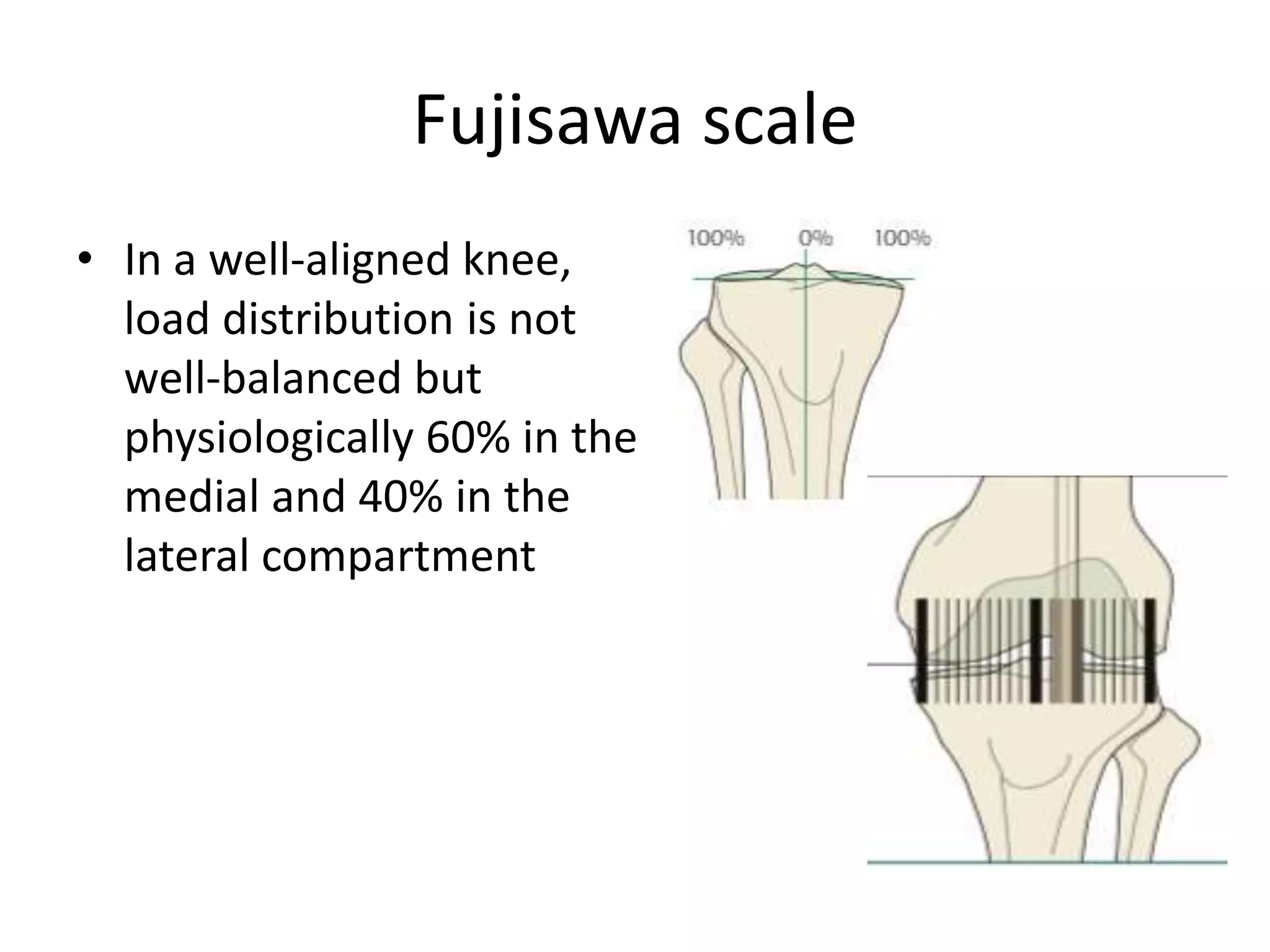 Fujisawa scale
• In a well-aligned knee,
load distribution is not
well-balanced but
physiologically 60% in the
medial and 40% in the
lateral compartment
 