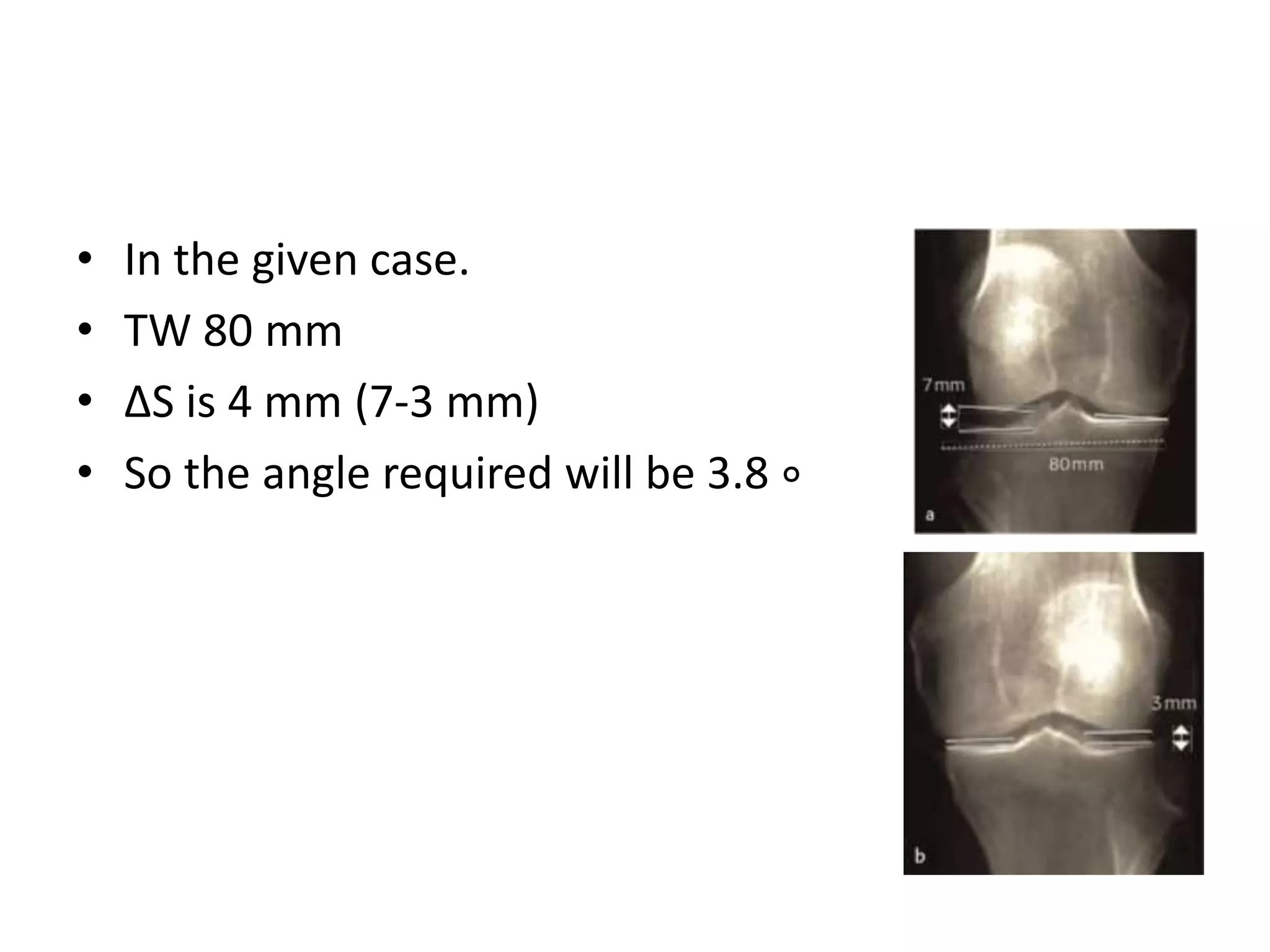 • In the given case.
• TW 80 mm
• ∆S is 4 mm (7-3 mm)
• So the angle required will be 3.8 ∘
 