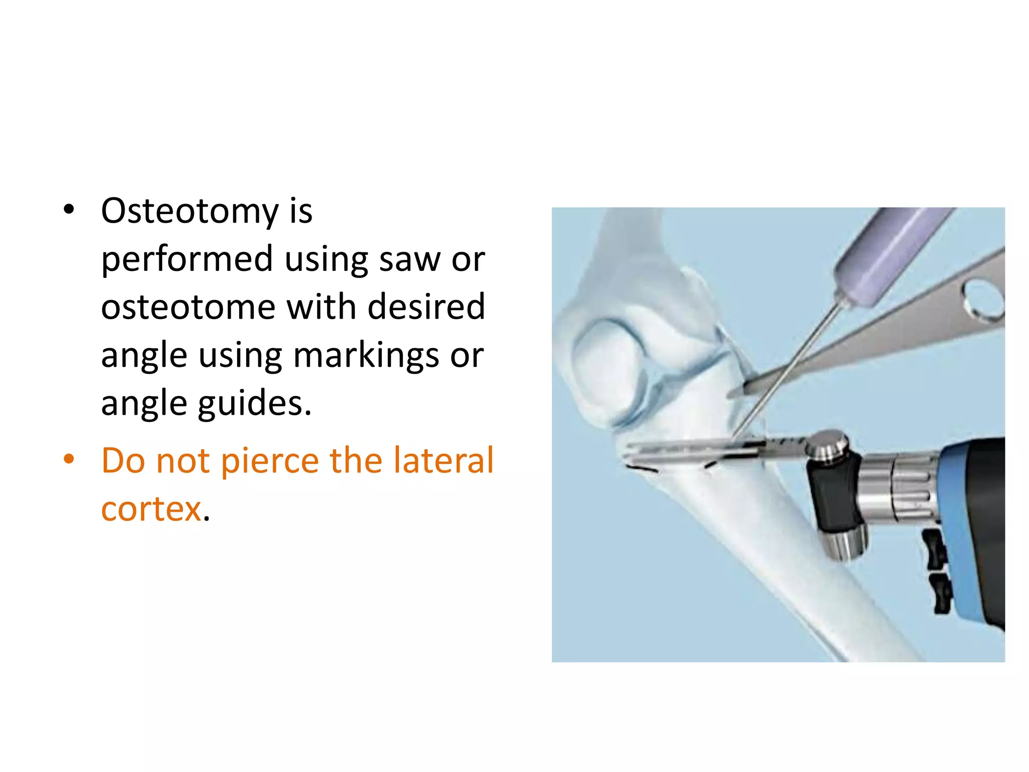• Osteotomy is
performed using saw or
osteotome with desired
angle using markings or
angle guides.
• Do not pierce the lateral
cortex.
 