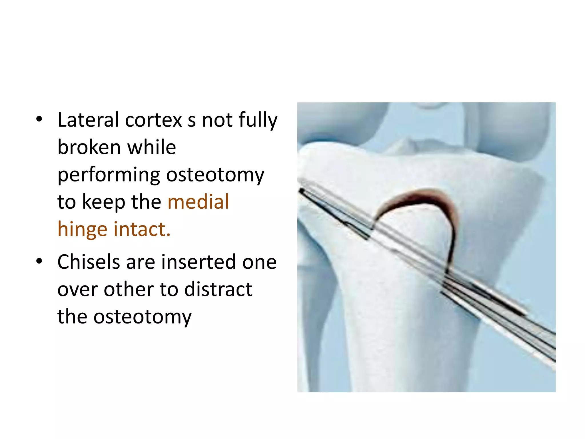 • Lateral cortex s not fully
broken while
performing osteotomy
to keep the medial
hinge intact.
• Chisels are inserted one
over other to distract
the osteotomy
 