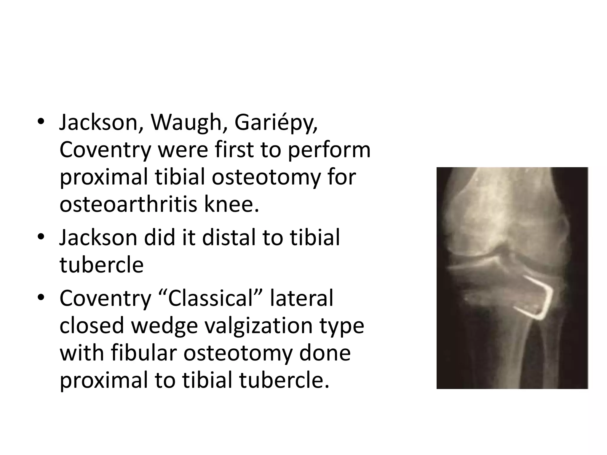 • Jackson, Waugh, Gariépy,
Coventry were first to perform
proximal tibial osteotomy for
osteoarthritis knee.
• Jackson did it distal to tibial
tubercle
• Coventry “Classical” lateral
closed wedge valgization type
with fibular osteotomy done
proximal to tibial tubercle.
 