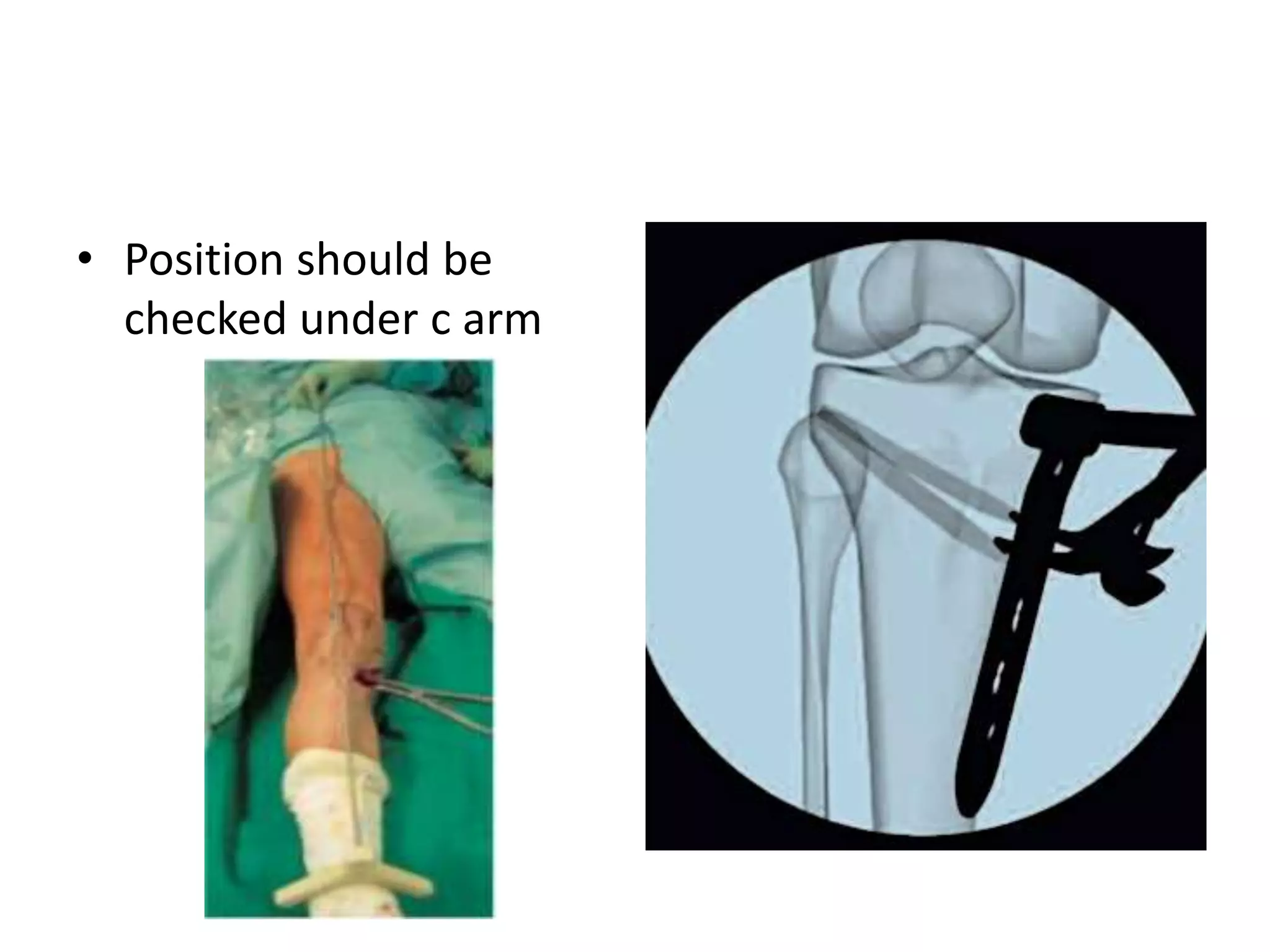 • Position should be
checked under c arm
 