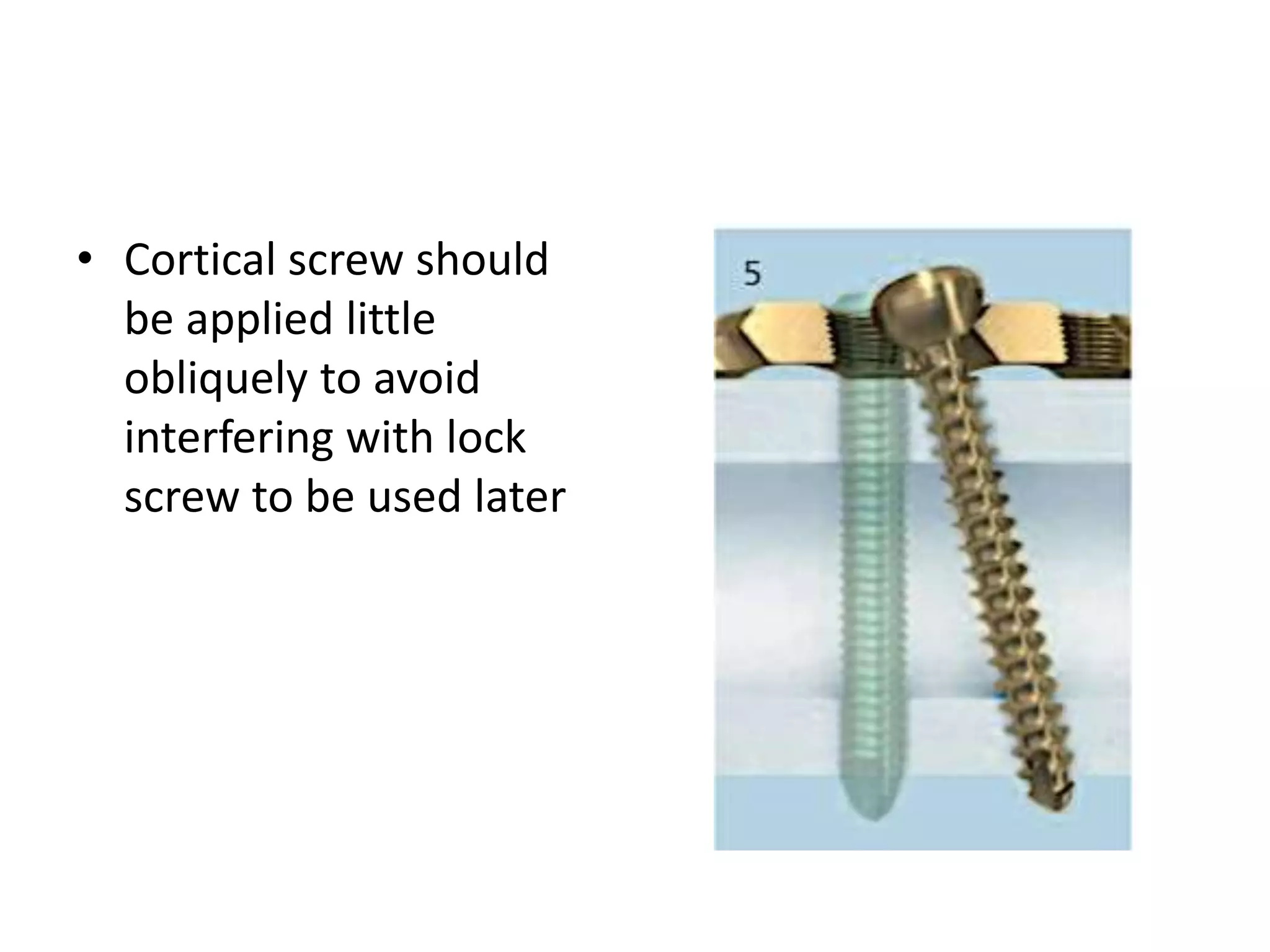 • Cortical screw should
be applied little
obliquely to avoid
interfering with lock
screw to be used later
 