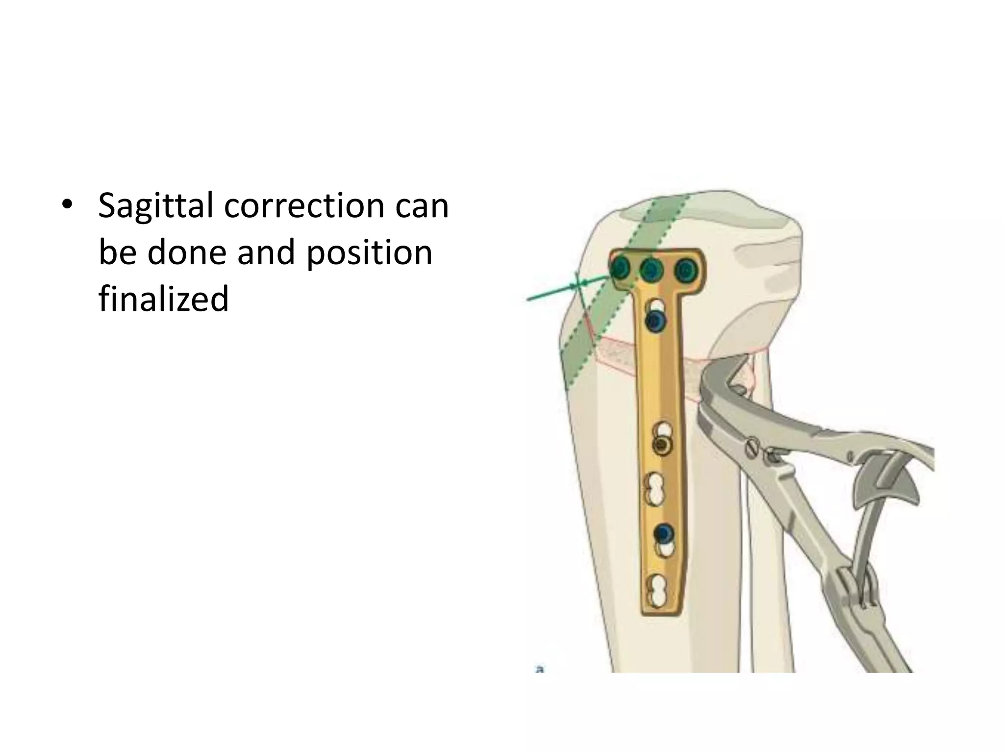 • Sagittal correction can
be done and position
finalized
 