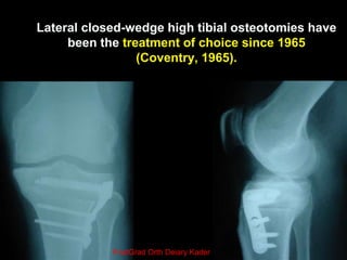 OPEN Wedge HTO 1987
 The open-wedge high tibial osteotomy
gained recognition after the encouraging
reports of (Hernigou e...