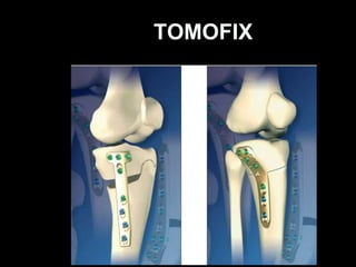 Proximal or High Tibial Osteotomy (HTO)
The IDEAL candidate for HTO
Age <60 years
Isolated medial OA
Good ROM
Less tha...