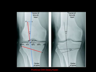 Tibial bone varus angle
(TBVA)
constitutional tibia varus malalignment when
the TBVA angle measured more than 5º
Mid Tibia...