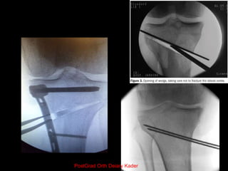 Lateral Open Wedge Distal Femur
 single cut
 easier approach to femur
 easily adjustable correction
 supratrochlear ar...