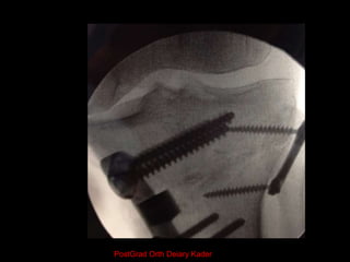 Methods of osteotomy Fixation
 Cast immobilisation
 Staples
 Plate and screw
 External fixator
 Distraction osteogene...