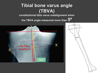 High Tibial Osteotomy and UniKnee for PostGrad Orth FRCS Course | PPTX