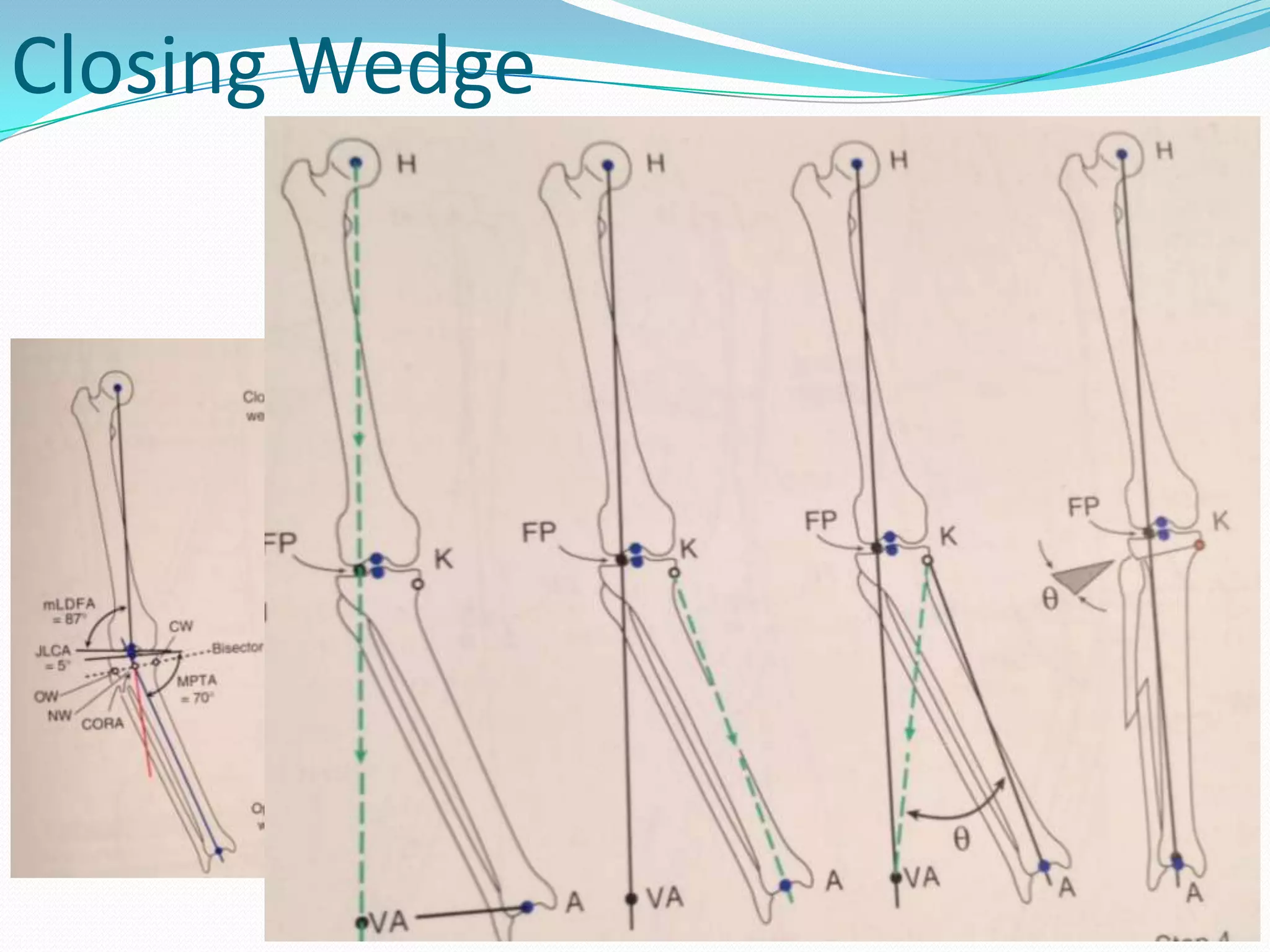 Closing Wedge
 
