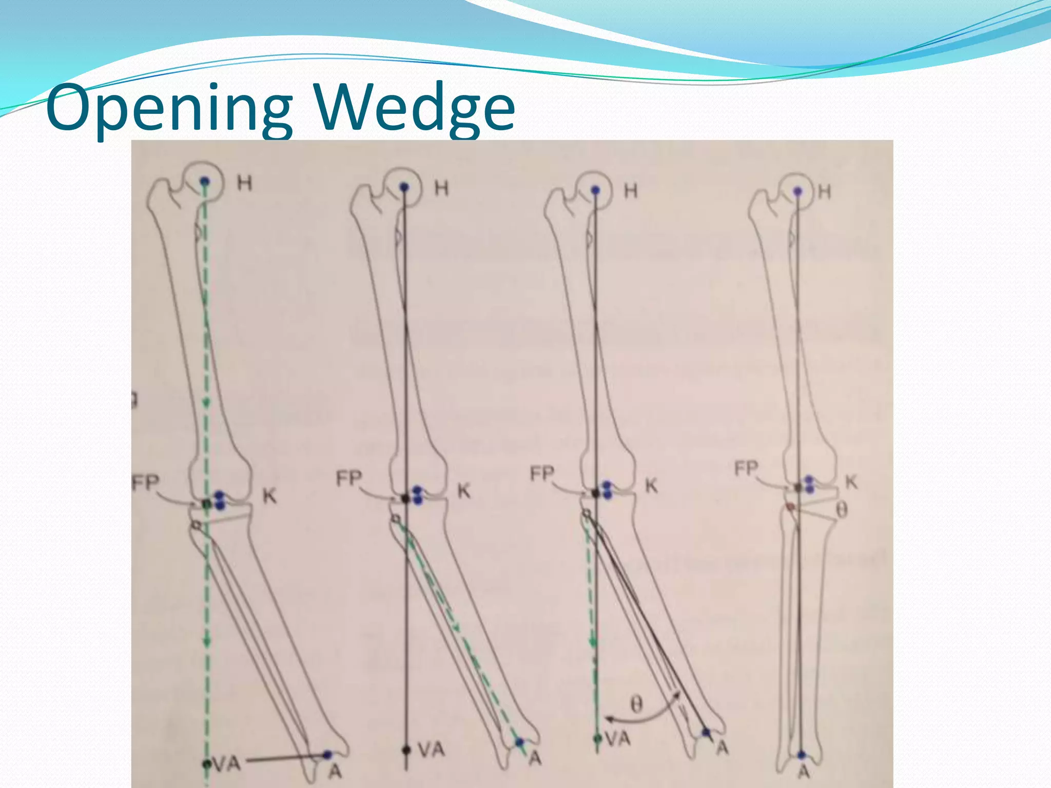 Opening Wedge
 