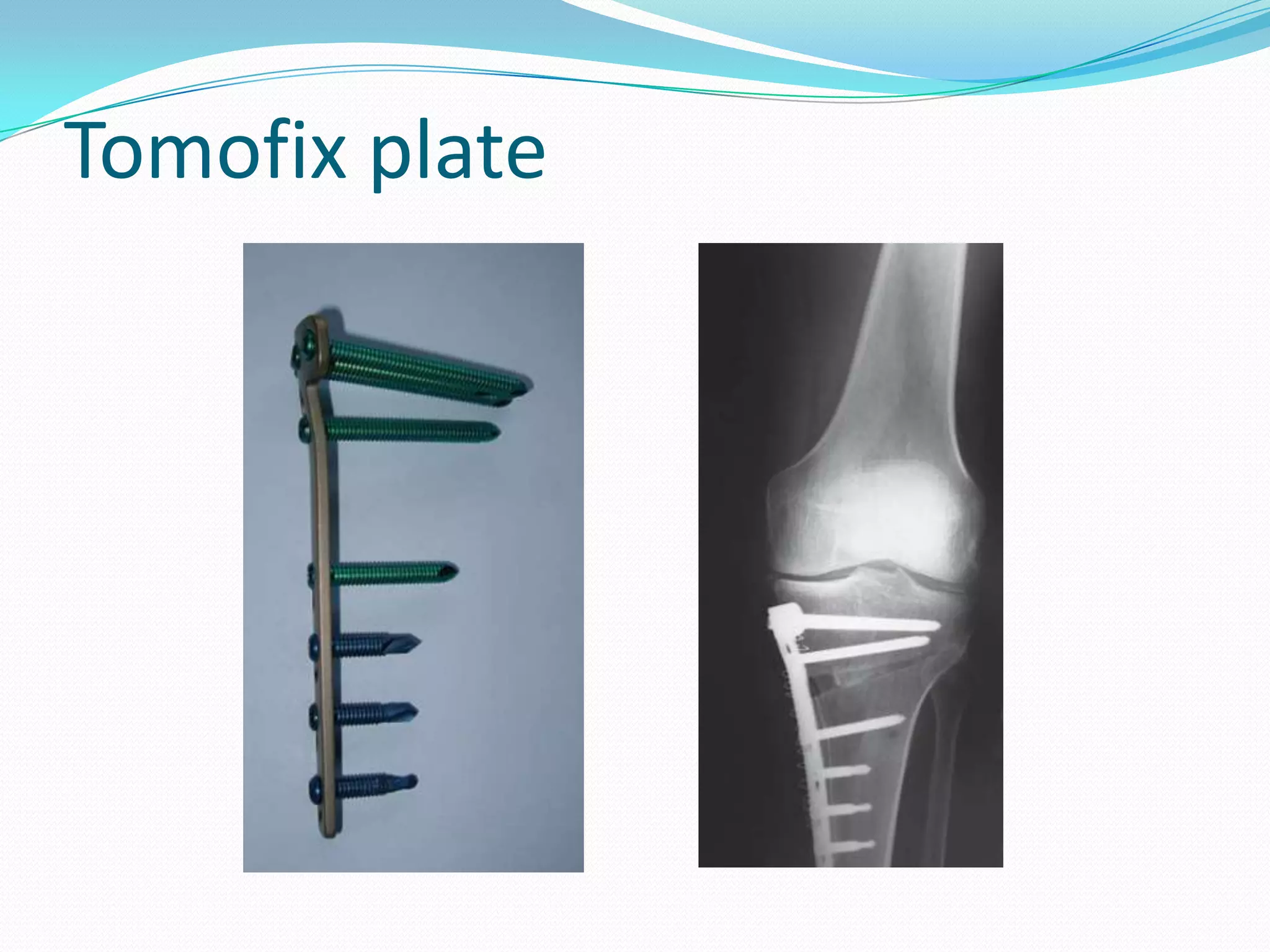 Tomofix plate
 