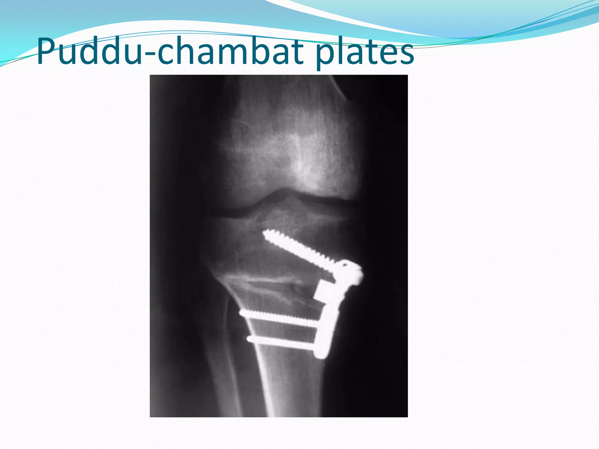 Puddu-chambat plates
 