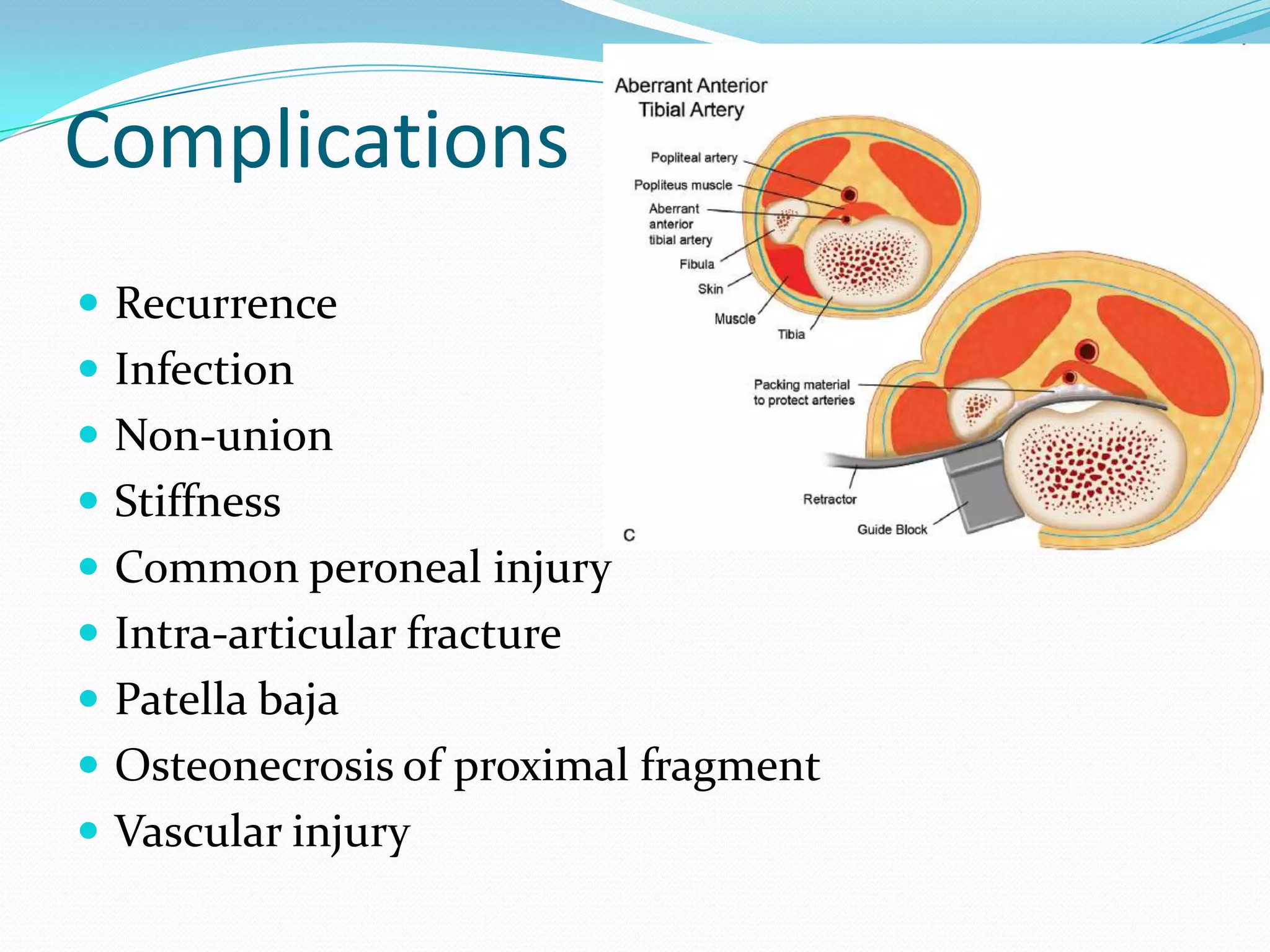 Complications
 Recurrence
 Infection
 Non-union
 Stiffness
 Common peroneal injury
 Intra-articular fracture
 Patella baja
 Osteonecrosis of proximal fragment
 Vascular injury
 