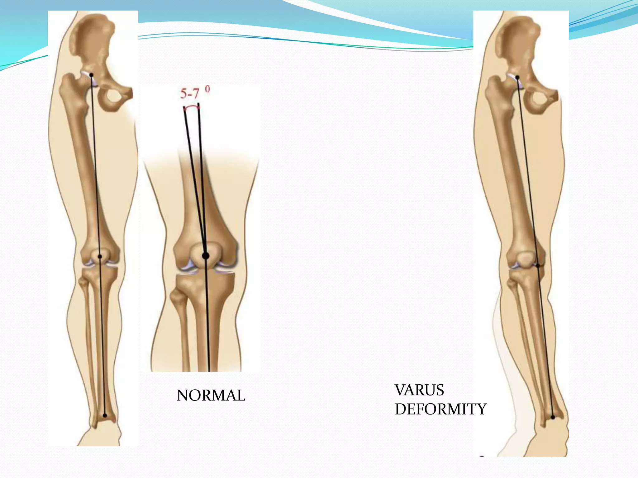 NORMAL VARUS
DEFORMITY
 