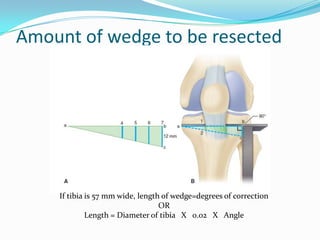 Amount of wedge to be resected
If tibia is 57 mm wide, length of wedge=degrees of correction
OR
Length = Diameter of tibia X 0.02 X Angle
 