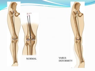 NORMAL VARUS
DEFORMITY
 