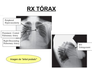 RX TÓRAX
Imagen de "árbol podado"
 
