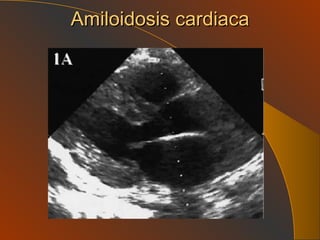 Amiloidosis cardiaca 